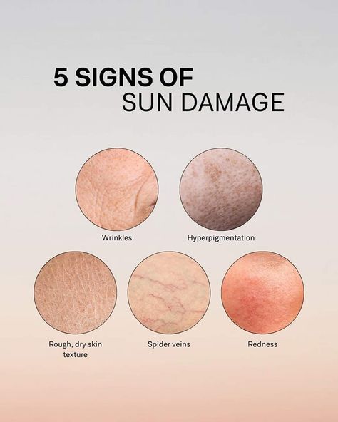 Your skin is your body’s largest organ, and it’s important to protect it! Some key signs of skin damage include dryness and flaking, redness and inflammation, wrinkles and fine lines, dark spots and hyperpigmentation, spider veins, and rough texture. Prevention is key! Make sure to wear sunscreen daily, stay hydrated, wear protective clothing, and moisturize regularly. Take care of your skin today for a healthier tomorrow! Signs Of Damaged Skin Barrier, Skin Theory, Product Post Design, Damaged Skin Barrier, Product Post, Skin Facts, Salon Quotes, Sun Damaged Skin, Take Care Of Your Skin