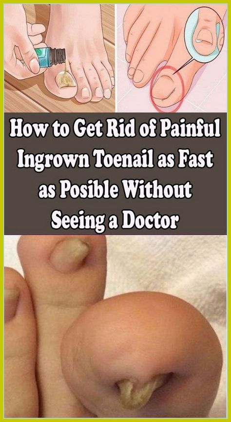 How To Get Rid Of A Painful Ingrain Nail Without a Doctor Ingrown Toenail, Ingrown Nail, Fungal Nail, Ingrown Toe Nail, Toenail Fungus, Chronic Inflammation, Nail Fungus, Patient Experience, Healthy Nails