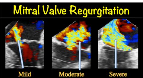 Mitral Valve Regurgitation (Mitral Insufficiency) myheart.net Mitral Valve Regurgitation, Studying Hacks, Bicuspid Aortic Valve, Cardiac Sonography, Diagnostic Medical Sonography, Mitral Valve, Heart Valves, Open Heart Surgery, Medical Photos