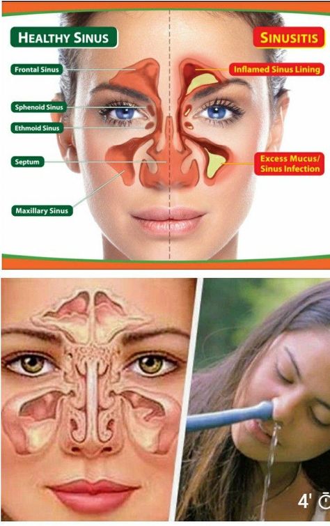 Sinusitis Ubicación #10TipsForGoodHealth Remedy For Sinus Congestion, Home Remedies For Sinus, Ear Reflexology, Sinus Congestion Relief, Summer Health, Healthy Life Hacks, Lower Back Pain Exercises, Sinus Congestion, Spine Health