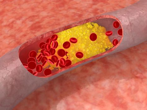 Heart Arteries, Heart Blockage, Clogged Arteries, Clean Heart, Ldl Cholesterol, High Cholesterol, Heart Healthy Recipes, Cholesterol Levels, Heart Healthy