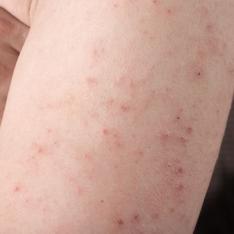 Picture of an arm with a dermatitis herpetiformis rash from eating too much gluten Skin Rashes Pictures, Allergy Rash, Itchy Skin Rash, Itchy Rash, Home Remedies For Skin, Home Remedies For Acne, Gluten Sensitivity, Sports Medicine, Itchy Skin