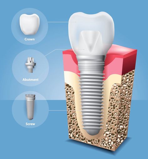 Dental Illustration, Prosthetic Teeth, Free Dental Implants, Dental Advertising, Dentist Teeth, Best Dental Implants, Oral Surgeon, Human Teeth, Dental Design