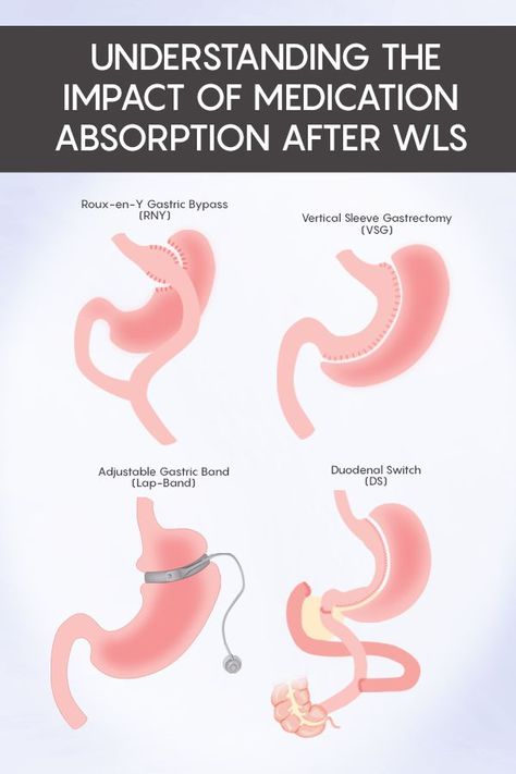 Medications are absorbed differently after bariatric surgery. Depending on the procedure and medication, make sure you discuss all medications with your surgeon. As general information, check out the overview so that you can learn about your procedure! #NSAIDS #bariatricsurgery #wls #weightlosssurgery #rny #gastricbypass #vsg #verticalsleeve #ds #duodenalswitch #lapband Duodenal Switch Surgery, Gastric Bypass Revision Surgery, Wls Before And After, Modified Duodenal Switch, Sadi-s Surgery, Bariatric Portions, Sleeve Surgery Before And After, No Chew Foods After Surgery Bariatric, Gastric Bypass Before And After