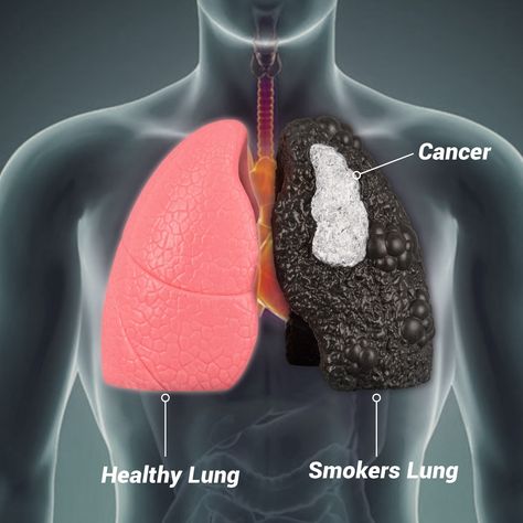 ✨✨Dive into the stark contrast between a healthy lung and a smoker's lung with our detailed model set! This educational tool is perfect for showcasing the effects of smoking, enhancing patient communication, and supporting public health initiatives. 🔍 Features: Two models: one healthy lung and one smoker's lung Ideal for education and awareness campaigns Explore more and elevate your health education: https://www.ultrassist.com/products/healthy-lung-vs-smokers-lung-model-set #LungHealth #S... Lung Model, Smokers Lungs, Human Anatomy Model, Suture Kit, Lung Health, Healthy Lungs, Anatomy Models, Lungs Health, Awareness Campaign