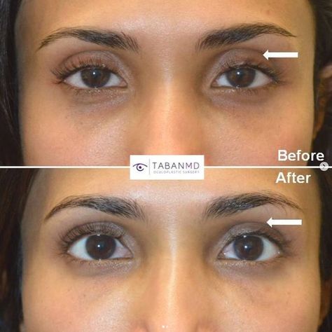 Beautiful young woman underwent #uppereyelidfiller injection for hollow sunken upper eyelids. Causes of sunken hollow upper eyelids include: genetics, aging, weight loss, prior surgery, Latisse, certain glaucoma drops, etc. Visit https://www.tabanmd.com/eyelid-filler-injection-specialist/ . www.TabanMD.com 📧 Office@tabanmd.com ☎️ 310-278-1836 Hollow Under Eyes, Beverly Hills Los Angeles, Injectables Fillers, Upper Eyelid, Under Eyes, Eye Surgery, Plastic Surgery, Beverly Hills, Surgery