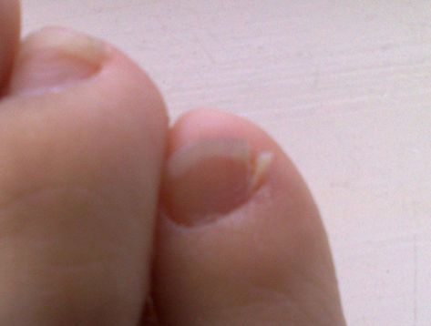 Nail Infection Broken Toenail, Split Toenail, Toenail Problems, Nail Remedies, Split Nails, Nail Problems, Foot Nail, How To Do Splits, Ingrown Nail