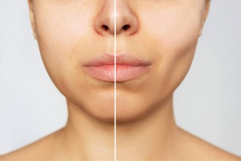 From Plump Cheeks to Chiseled Features: The Risks and Rewards of Buccal Fat Removal - StyleCheer.com Buccal Fat Removal, Natural Hair Removal Remedies, Facial Nerve, Reduction Surgery, Slimmer Face, Body Hair Removal, Lea Michele, Unwanted Hair Removal, Fat Removal