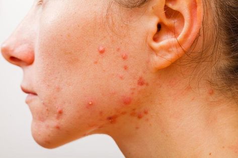 Acne Diet Plan, Jawline Acne, Clear Acne Fast, Hormonal Acne Diet, Hormonal Acne Remedies, Acne Diet, Pimples Under The Skin, Skin Diet, Natural Acne Remedies