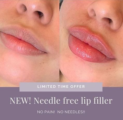 Needle Less Lip Filler, Needleless Lip Filler, Lip Threading Before And After, Hyaluron Lip Filler, Lip Filler Shape Ideas, Lip Filler Before And After, Lip Fillers Juvederm, Needle Injection, Lip Threading