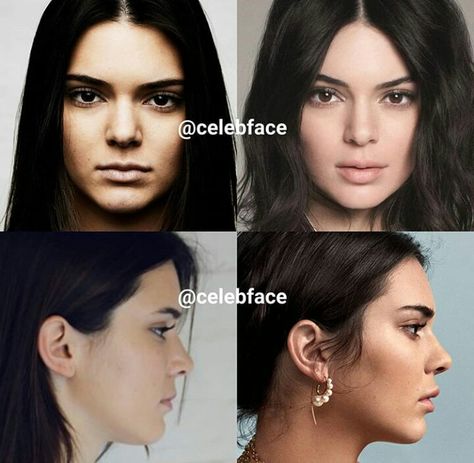 Kendall Jenner Kendall Jenner Plastic Surgery, Nonsurgical Nose Job, Forehead Lift, Chin Implant, Hair Implants, Facial Contouring, Nose Surgery, Facial Plastic Surgery, Celebrity Plastic Surgery