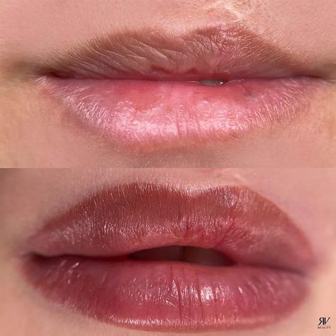 Medical Micropigmentation Overview: Beyond Aesthetics Lip Injection Aesthetic, Lip Micropigmentation, Small Mouth With Lip Injections, Filler Migration Lips, Cosmetic Lip Tattoo, Cupid Lips Filler, Permanent Lipstick, Ombre Lips, Lip Tattoos