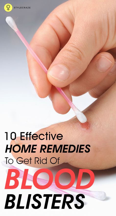 Blood blisters happen when the blood vessels under the skin surface get damaged. Though not very harmful, they cause terrible pain. Here are ... Blood Blister Remedy How To Get Rid, Blisters Remedies, Natural Blood Thinners, Chafing Remedies, Heal Blisters, Blood Blister, Blister Remedies, Skin Blisters, Pimples Under The Skin