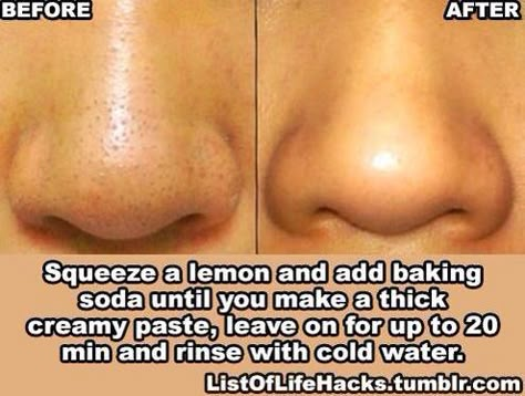 Skin Tips For Acne, Tips For Acne, Beauty Remedies, Diy Beauty Hacks, Mint Julep, Healthy Skin Care, My Chemical, Face Skin Care, Health And Beauty Tips