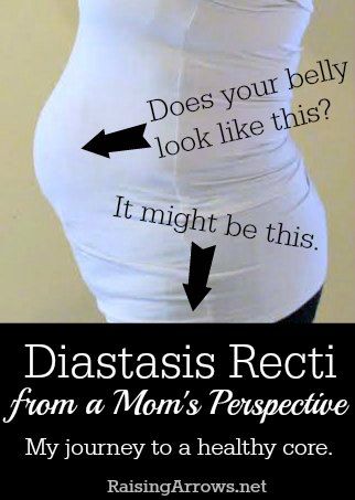 I'm not pregnant, but I look like I am.  I have a condition few health care professional seem to know about or address.  This is my story. Diastasis Recti Repair, Keto Fasting, Healing Diastasis Recti, Post Baby Workout, Diastasis Recti Exercises, Post Pregnancy Workout, Baby Workout, Post Baby Body, Diastasis Recti