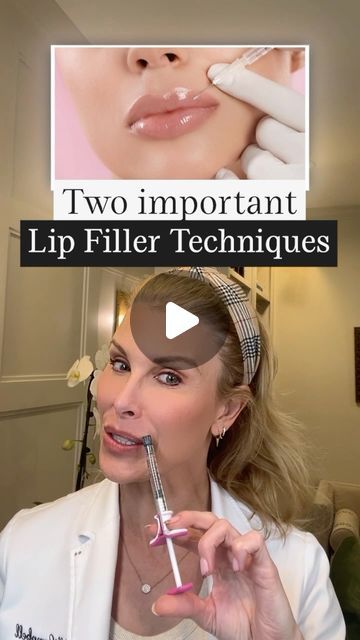 Migrated Lip Filler, Lip Flip Vs Filler, Lip Filler Technique, 1 Syringe Lip Filler, Lip Filler Shape Ideas, 0.5 Ml Lip Filler Before And After, Lip Filler Before And After, 1ml Lip Filler, Upper Lip Wrinkles