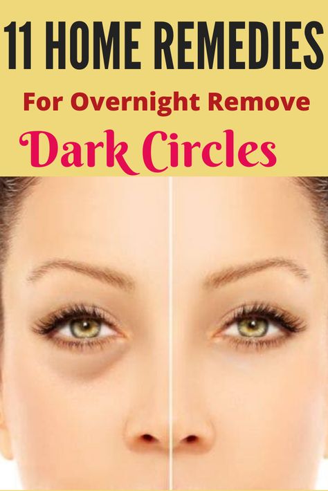 Overnight Beauty Tips, Dark Circle Remedies, Getting Rid Of Dandruff, Dark Eye Circles, Natural Beauty Remedies, Overnight Beauty, Remove Dark Circles, Spots On Face, Under Eyes