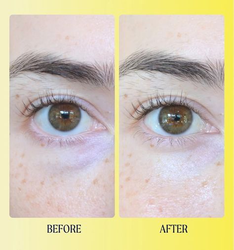 The proof is in the goop. Swipe for some results that make Brightwave Eye Cream the product people keep coming back for. ⠀⠀⠀⠀⠀⠀⠀⠀⠀ #Kinship #Brightwave #DarkCircles #VitaminC #EyeCream #SensitiveSkin #SensitiveSkincare Vitamin C Eye Cream, Brightening Eye Cream, Eye Brightener, Dark Under Eye, Sensitive Skin Care, Wide Awake, Tired Eyes, Dermatologist Recommended, Eye Area