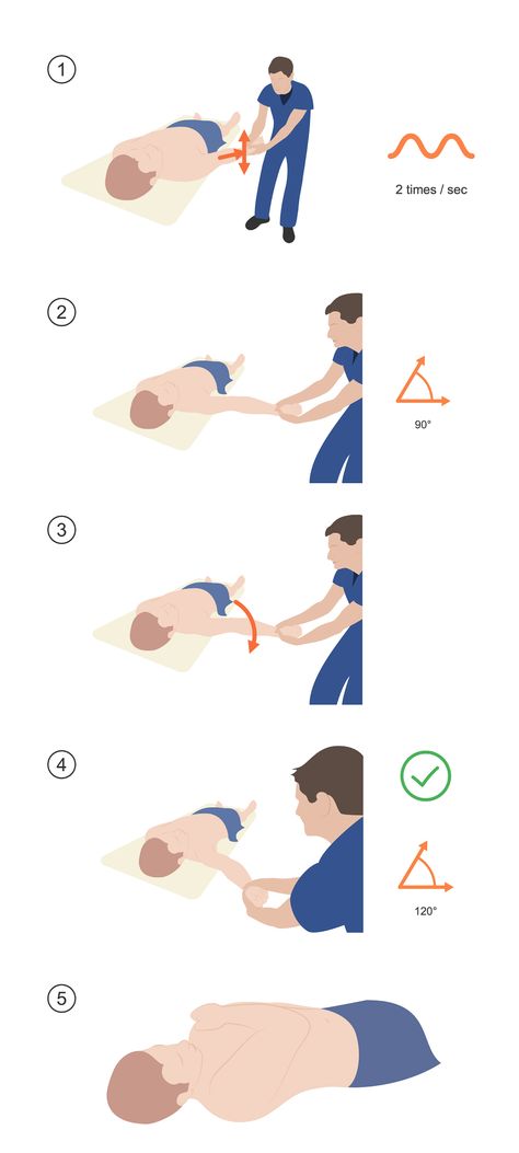 Figure 1. Reducing a shoulder with the FARES technique. 1) Apply traction and oscillate the arm. 2) Gently abduct the arm to 90°. 3) Externally rotate the shoulder while continuing to oscillate and abduct the arm. 4) The reduction usually happens by 120°. Shoulder Instability, Muscle Spasms, Emergency Room, Keep Up, How To Apply