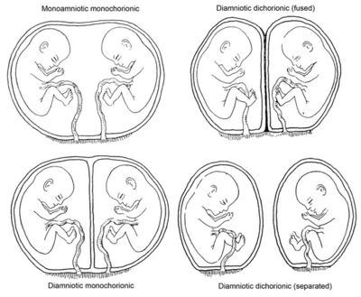 Fraternal Twins vs Identical Twins - Difference and Comparison Chinese Pregnancy Calendar, Twins In The Womb, Twins Ultrasound, Types Of Twins, Pregnancy Chalkboard, Medical Ultrasound, Pregnancy Calendar, Pregnancy Calculator, Twin Life