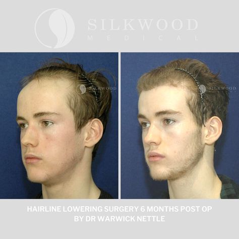 Hairline lowering surgery otherwise known as forehead reduction surgery enhanced my patients face creating better proportional balance. A high hairline in men and women can look ageing and alien like.  To find out more about this great procedure contact our rooms on;  T: (02) 9387 3900 W: www.silkwoodmedical.com.au E: reception@silkwoodmedical.com.au  #hairline #hairlineloweringsurgery #hairlinelowering #forehead #foreheadreduction #foreheadreductionsurgery #drnettle #drwarwicknettle Forehead Surgery, Forehead Reduction Surgery, Plastic Aesthetic, Forehead Reduction, Reduction Surgery, Facial Fillers, Haircut Pictures, Famous Celebrities, Plastic Surgery