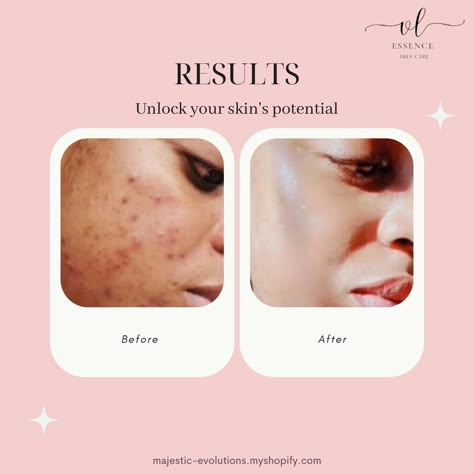 Unleash your skin's potential with our incredible before-and-after results! Experience the transformation for yourself and see why our elegant skincare products are the secret to radiant, healthy skin. majestic-evolutions.myshopify.com/?_ab=0&_fd=0&_sc=1 #skincare #beauty #antiaging #glowingskin #skincareroutine #healthyskin #naturalskincare #selfcare #organicskincare #crueltyfree #veganskincare #cleanbeauty #skincarecommunity #beautyproducts #facialcare Before And After Graphic Design Layout, Skin Before After, Before And After Template Instagram, Skin Before And After, Skincare Before And After, Dermatology Creative Ads, Before After Skincare, Skincare Creative Post, Before And After Template