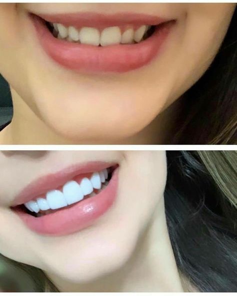 Before and after Straight Smile Aesthetic, Aesthetic Teeth Smile, Beautiful Smile Teeth Aesthetic, Straight Teeth Subliminal, Cute Teeth Aesthetic, Cute Gap Teeth, Teeth Subliminal Results, Pretty Teeth Aesthetic, Pretty Teeth Smile