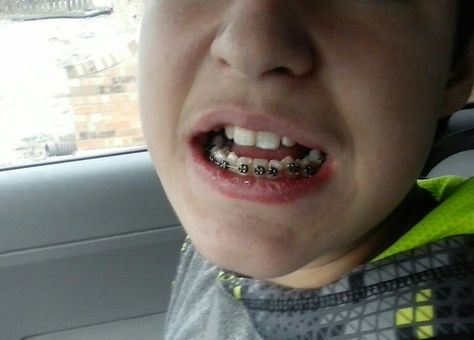 Caleb got his bottom braces today.....only 914 days left till he gets em off...lol Day Left, Braces, Got Him