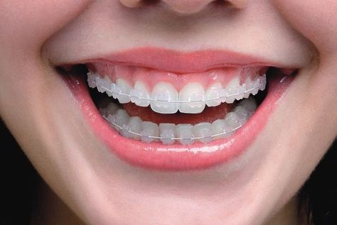 Perfect Teeth Braces, Invisible Braces Teeth, Orthodontics Teeth, Zoom Teeth Whitening, Ceramic Braces, Cute Braces Colors, Types Of Braces, Adult Braces, Braces Tips