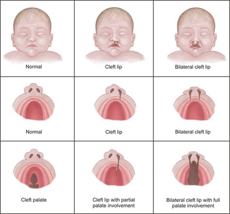 Midwifery Student, Cleft Lip And Palate, Cleft Palate, Cleft Lip, Medical Missions, Ob Nursing, Neonatal Nurse, Nursing Tips, Nursing Study