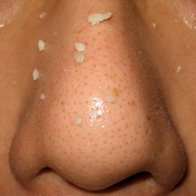 How To Remove Nose Blackheads Naturally #Beauty_Tips Nose Blackheads, Remove Blackheads From Nose, Exposed Skin Care, Acne Laser, Chicken Kebab, Kebab Recipe, Blackheads On Nose, Face Pores, Types Of Acne