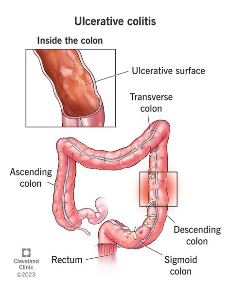 What Is Ulcerative Colitis? Inflammatory Bowel Syndrome, Sigmoid Colon, Signs Of Inflammation, Abdominal Cramps, Inflammatory Bowel, Irritable Bowel, Critical Care, Family Health, Health Conditions