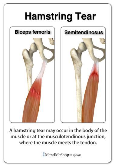 Semitendinosus Muscle, Stretches For Tight Hamstrings, Torn Hamstring, Muscle Belly, Muscle Tear, Psoas Release, Bursitis Hip, Schwarzenegger Bodybuilding, Hamstring Muscles