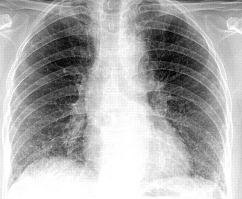 chest xray pneumonia ile ilgili görsel sonucu Chest Xray, X Ray, To Read, Abstract Artwork, Reading, Art