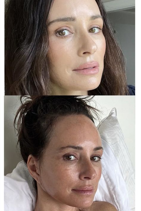 Facelift Recovery, Catt Sadler, Turning 50, Neck Lift, Under The Knife, Plastic Surgery, The Age, Surgery, Turning