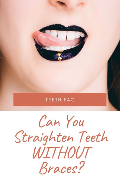 How To Get Straight Teeth, Straight Teeth Without Braces, Straighten Teeth Without Braces, Different Types Of Braces, Orthodontics Teeth, Straighten Teeth, Flossing Teeth, Lingual Braces, Ceramic Braces