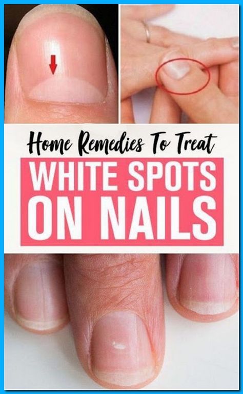 Top Home Remedies For White Spots On Finger Nails White Spots On Fingernails, White Spots On Nails, Food For Kidney Health, Nail Remedies, Home Medicine, Natural Beauty Remedies, Fungal Nail, Health Signs, Finger Nails