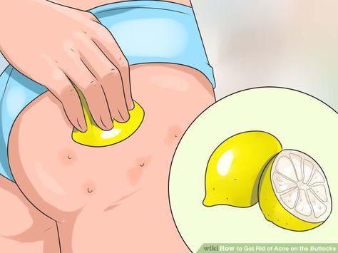 3 Ways to Get Rid of Acne on the Buttocks - wikiHow Buttocks Acne, Pimples On Buttocks, Acne Scar Remedies, Cystic Acne Remedies, Chest Acne, Forehead Acne, Acne Overnight, Get Rid Of Acne, Rid Of Acne