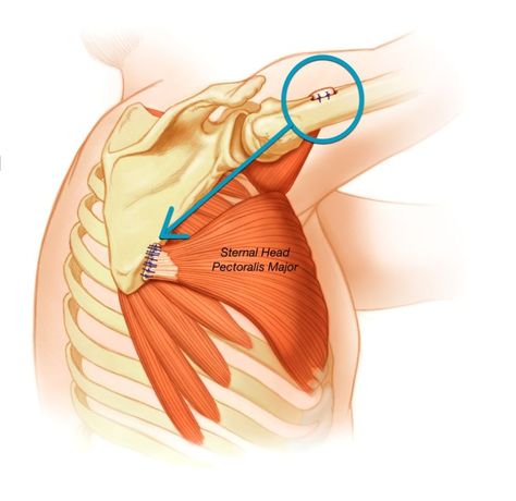 Impingement Shoulder, Serratus Anterior, Shoulder Anatomy, Shoulder Girdle, Rehabilitation Exercises, Body Mechanics, Human Body Anatomy, Muscle Anatomy, Medical Anatomy