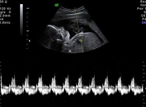 Baby's heartbeat Baby Heartbeat, Ultrasound, In A Heartbeat, Quick Saves