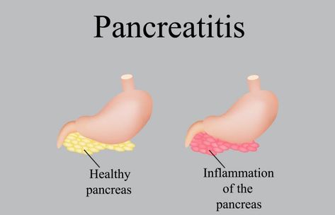 Pancreas Symptoms, Pancreas Diet, Pancreas Cleanse, Pancreatic Diet Recipes, Pancreas Health, Gallbladder Diet, Gallbladder Surgery, Gall Bladder, Digestive Problems