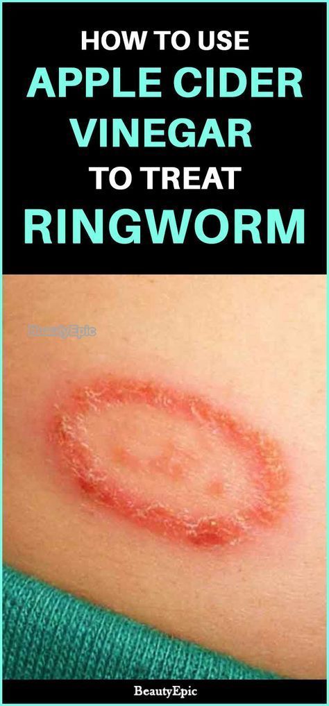 How to Use Apple Cider Vinegar To Treat Ringworm Ring Worm Remedies, Skin Moles, Apple Cider Vinegar Drink, Cold Home Remedies, Skin Cleanser Products, Natural Home Remedies, Cider Vinegar, Apple Cider Vinegar, The Skin