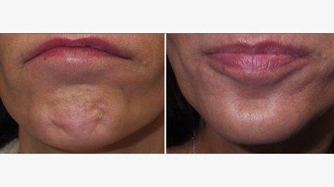 Weak Chin, Chin Wrinkles, Chin Filler, Sagging Face, Botox Before And After, Face Fillers, Botox Lips, Homemade Face Mask, Chin Exercises