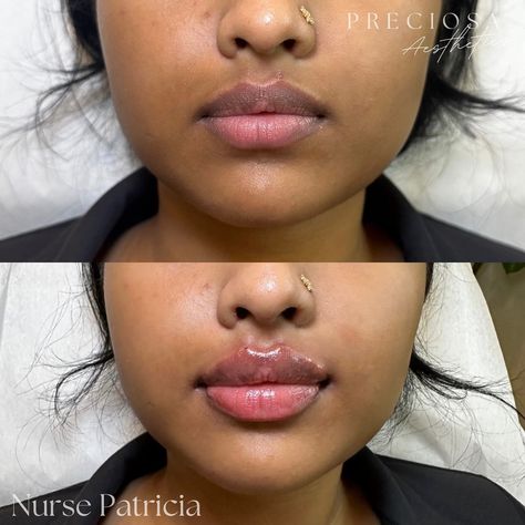 Signature Lips By Preciosa 👄 0.5 ml Lip Filler 💉✨ Book an appointment today! 🤍 📱 647-984-8802 🖥️ www.PreciosaAesthetics.com 📧 Preciosa.Aesthetics@hotmail.com 📍 102 Lakeshore Road East, Mississauga #lipfiller #filler #lips #beauty #aesthetics #botox #dysport #nucieva #chinfiller #cheekfiller #mississauga #portcredit #toronto #oakville #nurse #nurseinjector 0.5 Lip Filler, Lip Filler Black Women, Pouty Lip Filler, 2 Ml Lip Filler, Lip Filler Before And After, Natural Lip Fillers 0.5ml, 1ml Lip Filler, Kysse Lips Filler, Lip Filler Inspo 0.5ml