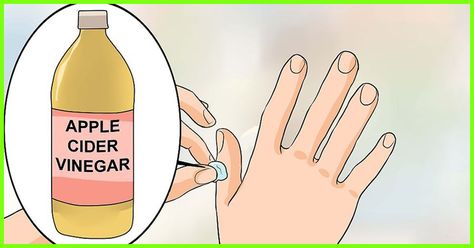 Filiform Wart, Warts Removal, Wart On Finger, Warts On Hands, Home Remedies For Warts, Warts Remedy, Get Rid Of Warts, Acne Remedies, Healthy Ideas