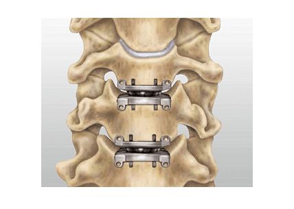 Cervical Disc, Physical Therapy Student, Lumbar Disc, Neck Surgery, Neck Exercises, Spine Surgery, Surgery Recovery, Industrial Design Sketch, San Michele