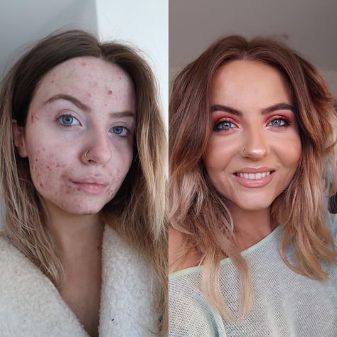 This foundation is going viral after cystic acne sufferer shares her amazing before-and-after pics Acne Coverage Makeup, Covering Acne With Makeup, Acne Pictures, Best Foundation For Acne, Acne Coverage, Covering Acne, Makeup Coverage, Acne Makeup, Makeup Hacks Beauty Secrets