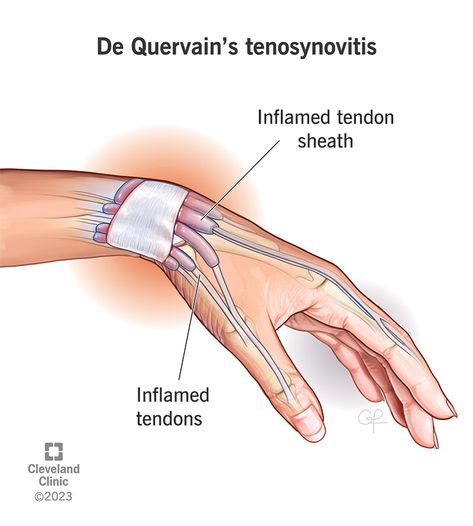 Signs Of Inflammation, Wrist Exercises, Cleveland Clinic, Medical Terms, Rare Disease, Human Services, Health Articles, Medical Professionals, Health Remedies