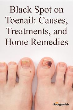 Fungal Nail Remedies Black Spot On Toenail, Black Toenail Fungus, Toenail Health, Nail Remedies, Antifungal Cream, Toenail Fungus Remedies, Nail Fungus Remedy, Fungal Nail, Tongue Health