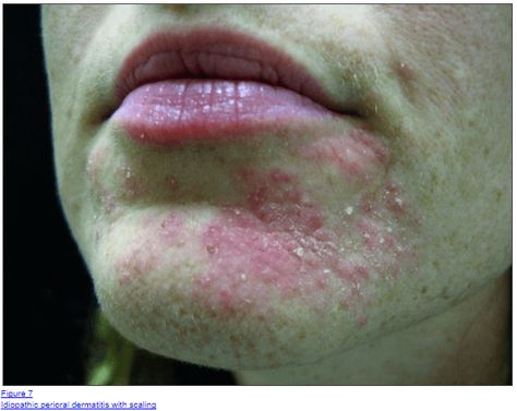 pictures of perioral dermatitis Dermatofibroma Home Remedy, Skin Irritation Remedies, Oil Cleanser Recipe, Dermitis Herpetiformis, Perioral Dermitis Skincare, Contact Dermitis Rash, Pityriasis Alba, Oil Cleanser, Skin Conditions